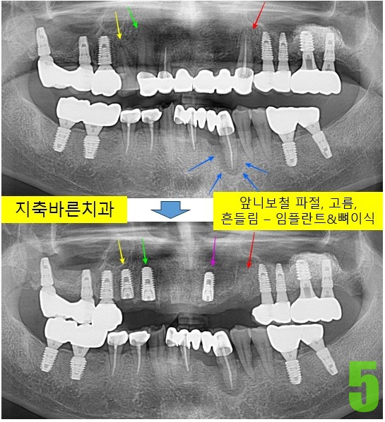 5. #14,13,21 식립.jpg