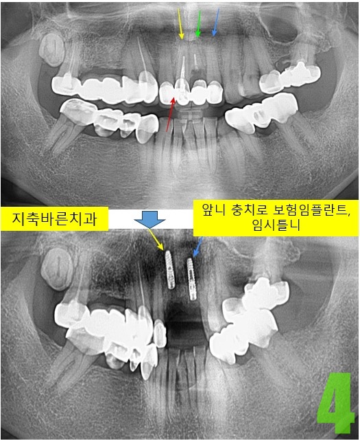 4. 앞니 보험임플.jpg