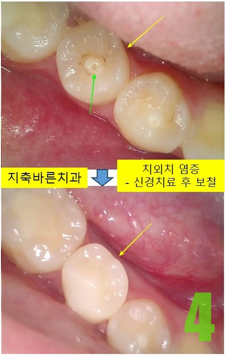 4. #45 크라운.jpg
