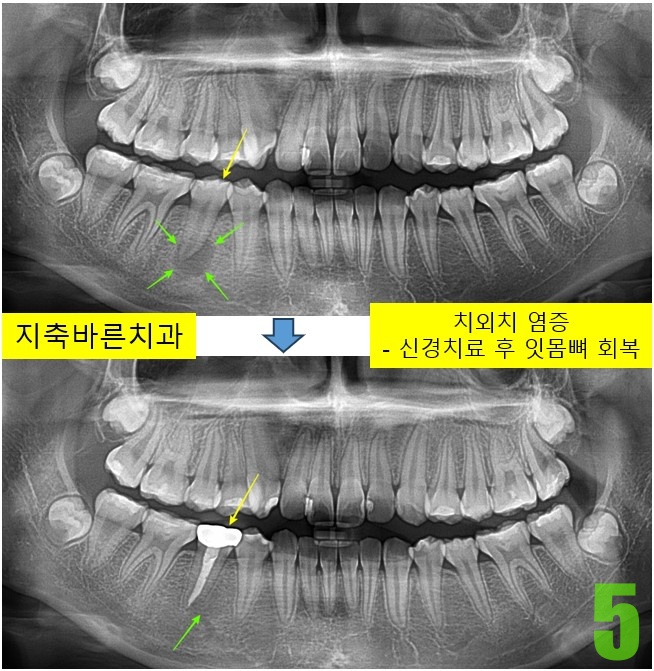 5. 치료후 4개월.jpg
