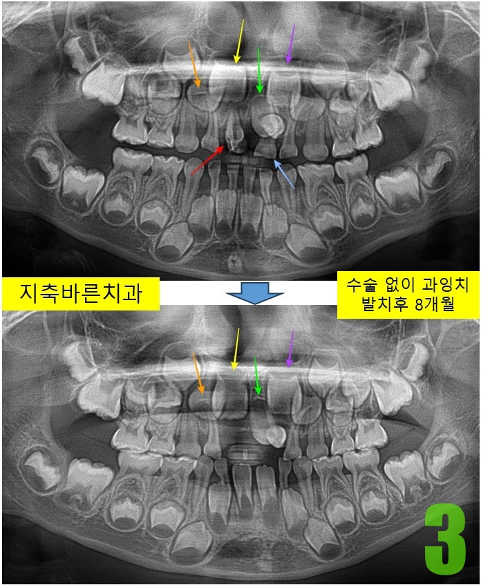 3. 발치 후 8개월.jpg