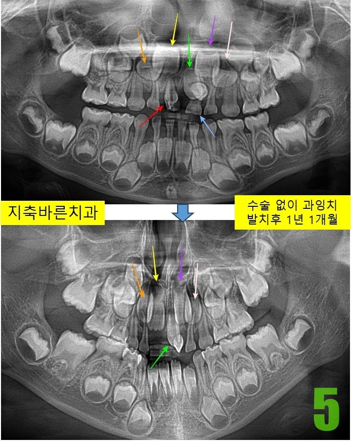 5. 발치 후 1년 1개월.jpg