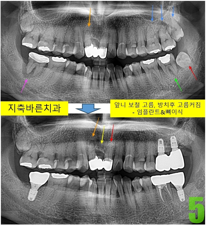 5. 1년 4개월 후 파노.jpg