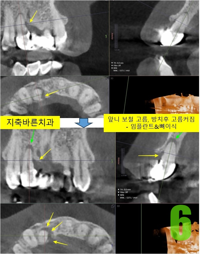 6. 1년 4개월 후 CT.jpg