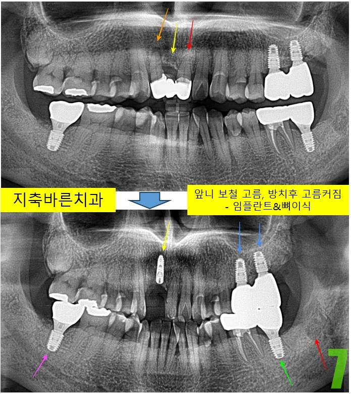 7. #11 임플 식립.jpg