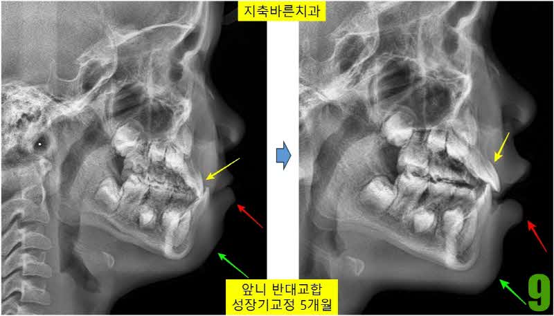 9. 치료전후 5개월 사진_s.jpg