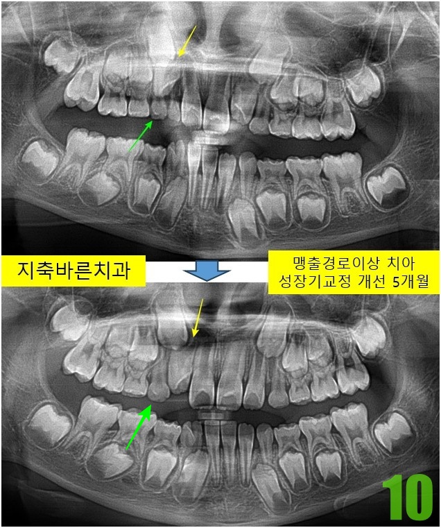 10. 치료전후 5개월 파노.jpg