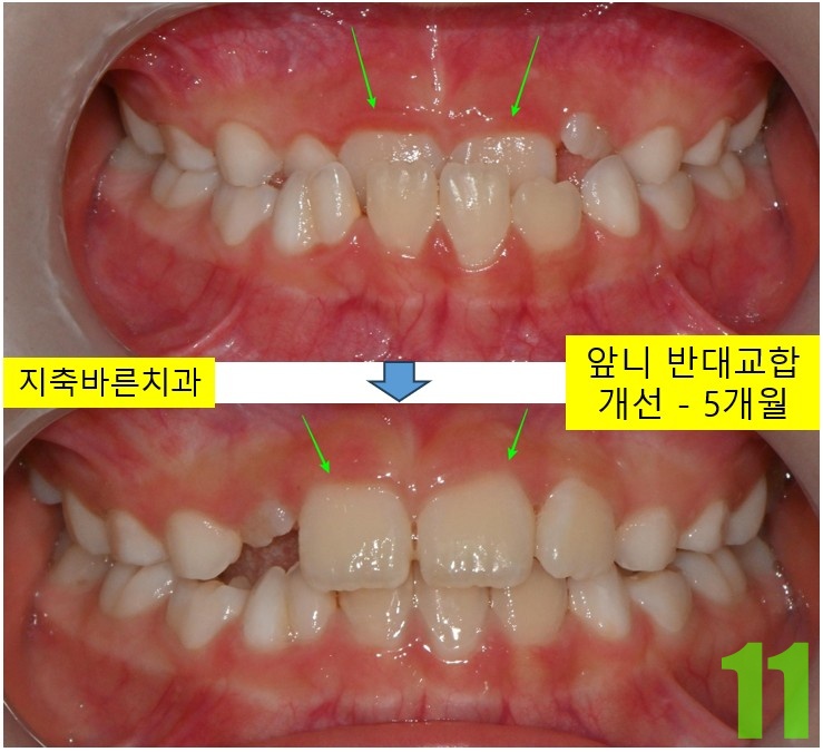 11. 치료전후 5개월 정면.jpg
