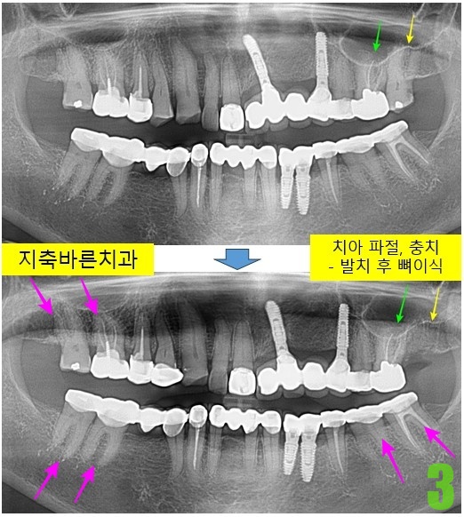 3. #27 발치, 뼈이식.jpg
