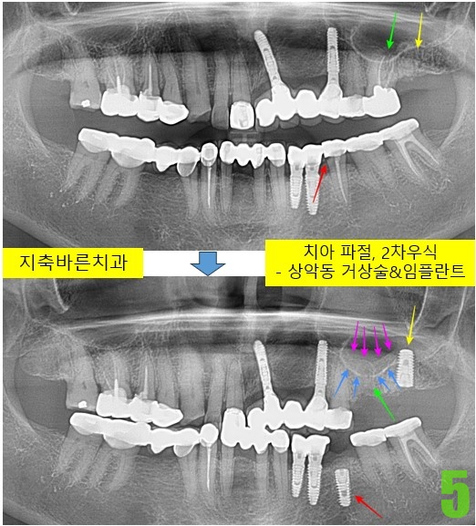 5. #26 발치, #27,35 임플 식립.jpg
