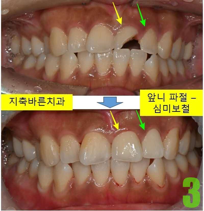 3. #21,22 치료 후_s.jpg