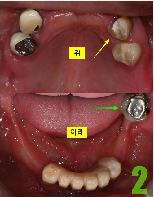 2. 초진 상악 교합면.jpg