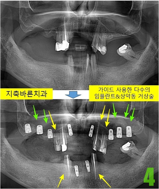 4. 상악동 거상술, 상악 임플란트, 하악전치 임플란트.jpg