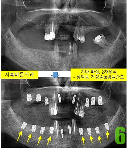 6. 하악 구치부 임플란트 식립.jpg