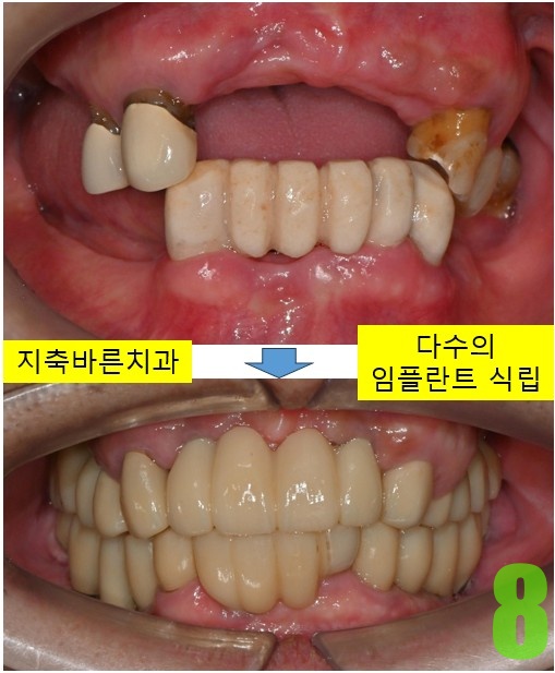 8. 치료전후 정면.jpg