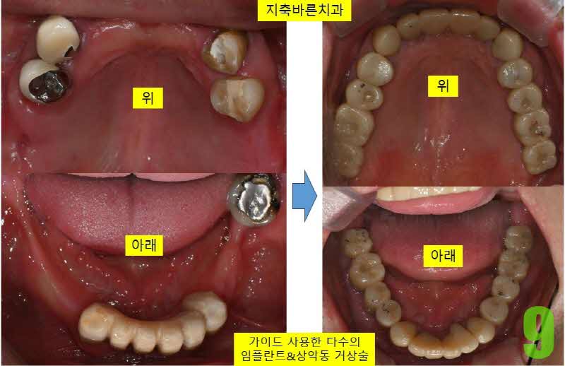 9. 치료전후 교합면_s.jpg