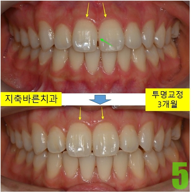 5. 치료전후.jpg