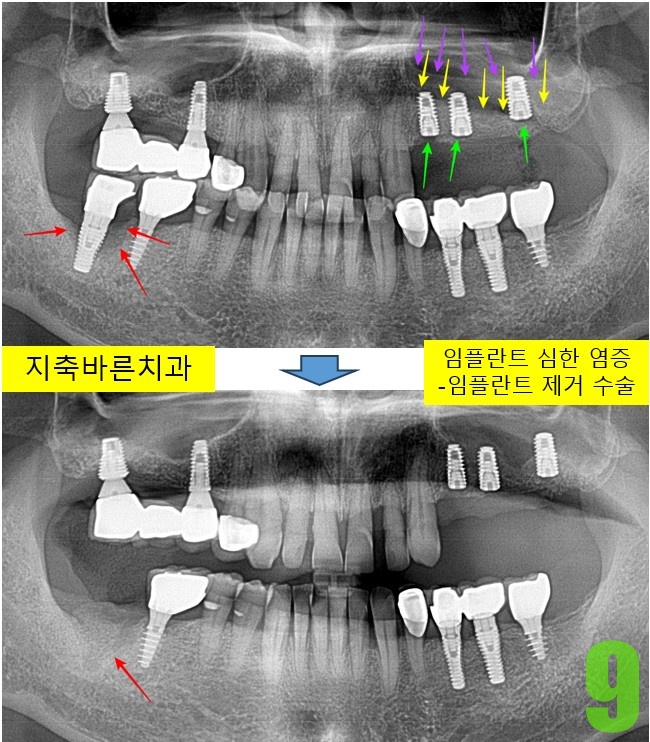 9. #47 타치과 임플 제거.jpg