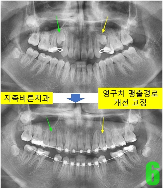 6. 치료 1년 파노.jpg