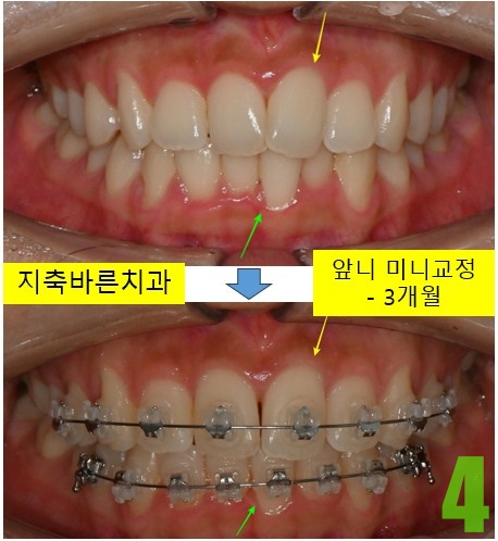 4. 교정 3개월 정면.jpg