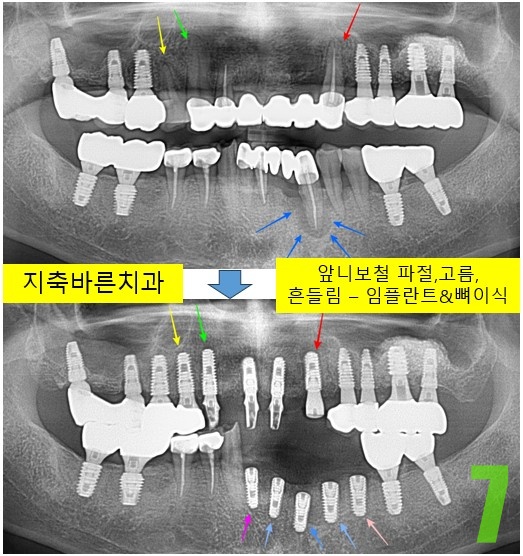 7. 4개월 후 하악전치 임플 식립.jpg