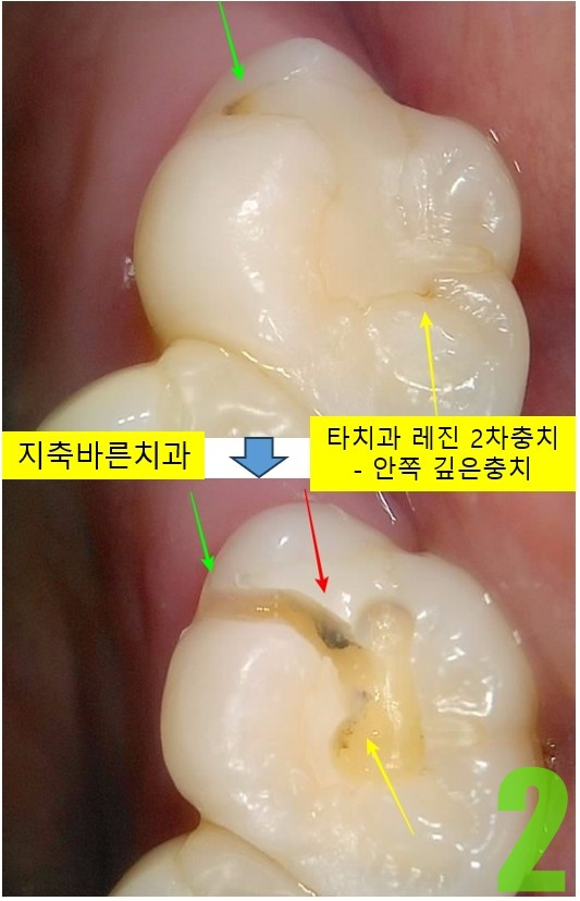 2. #17 충치치료중.jpg