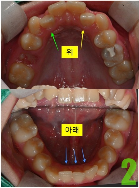 2. 초진 상하악.jpg