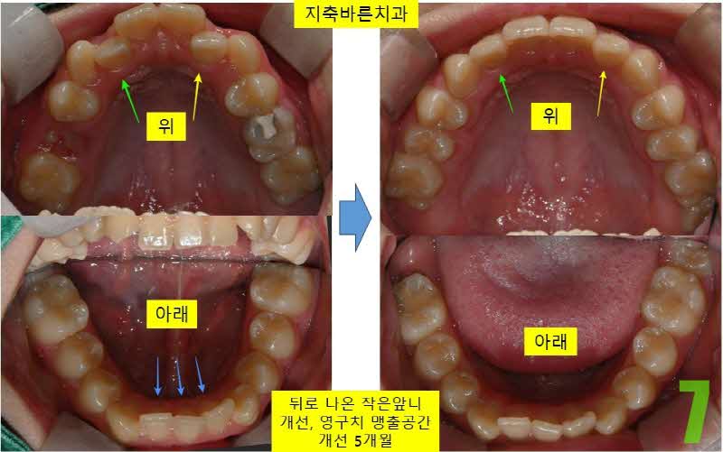 7. 5개월 상하악_s.jpg