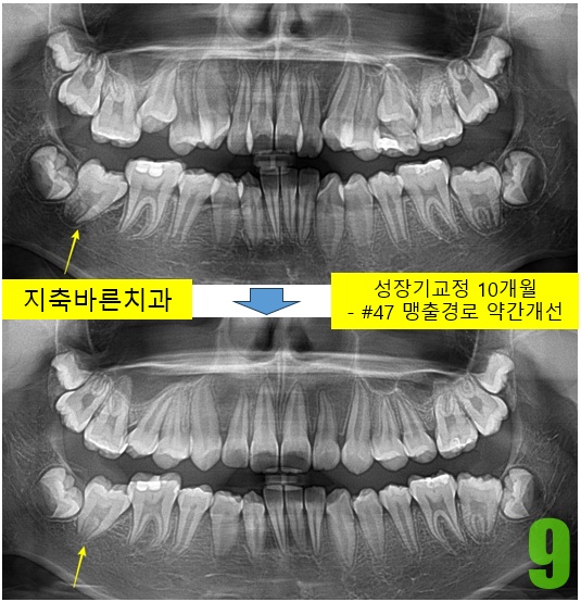 9. 8개월 파노.jpg