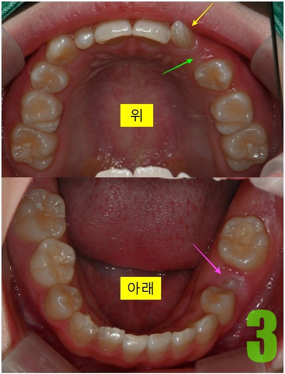 3. 초진 상하악.jpg