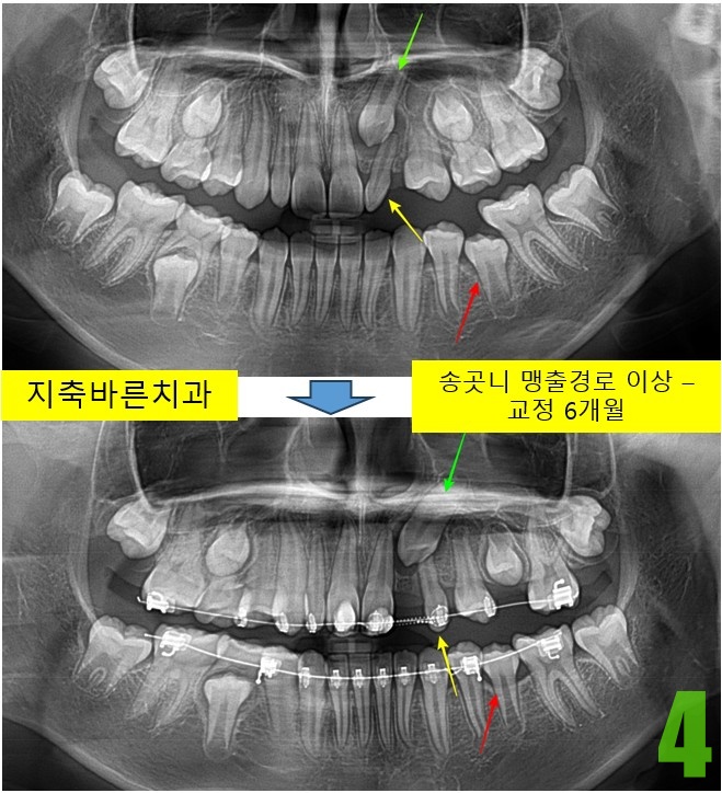 4. 교정 6개월.jpg