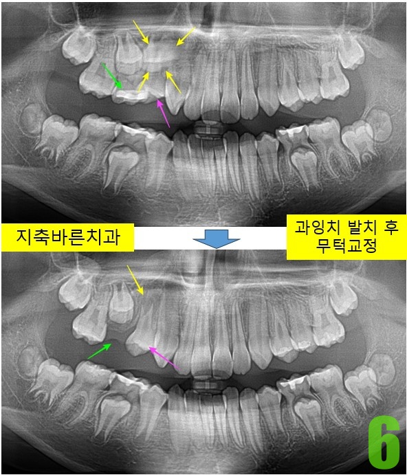 6. 과잉치 발치.jpg