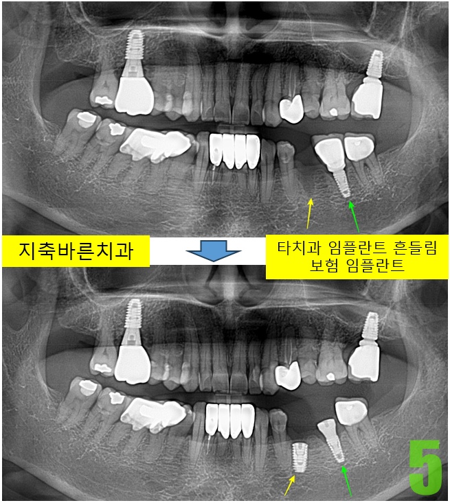 5. #35 임플식립.jpg