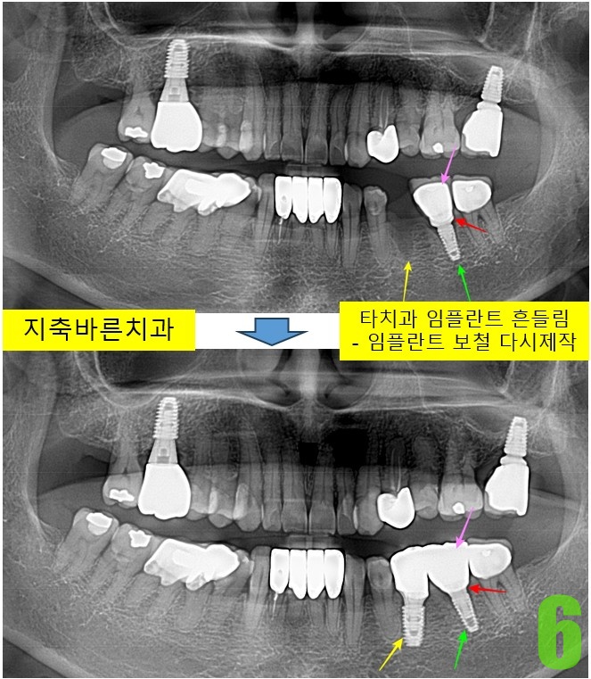 6. #35,36 보철.jpg