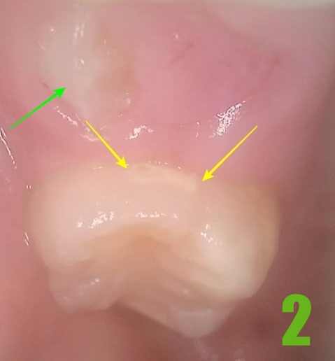 2. #16 치료전.jpg