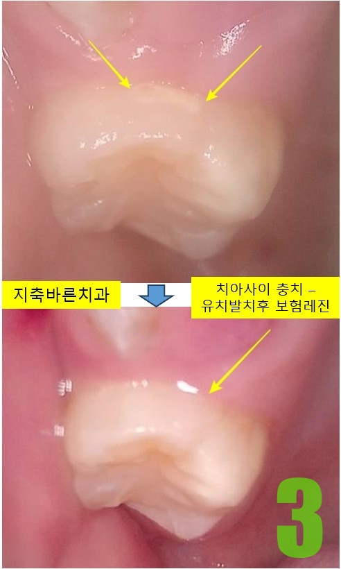 3. #16 치료전후.jpg