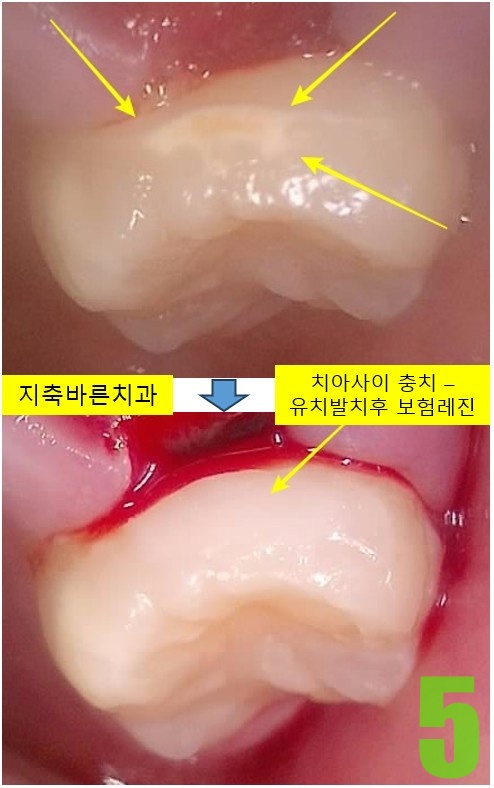 5. #26 치료전후.jpg