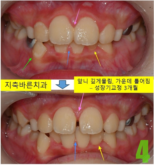 4. 3개월 정면.jpg