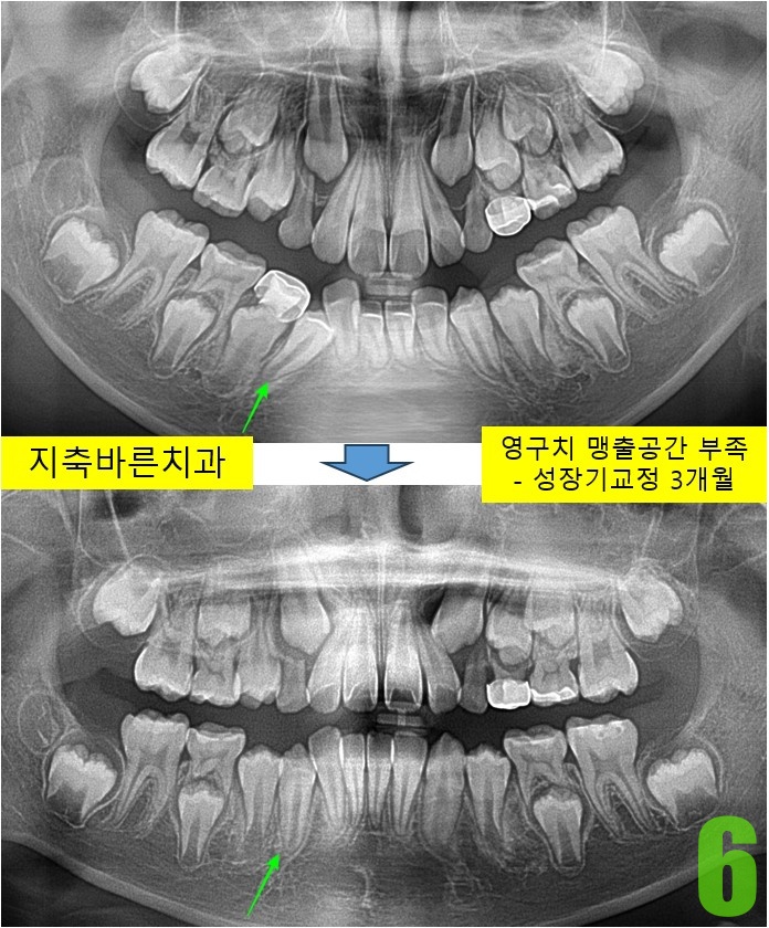 6. 3개월 파노.jpg
