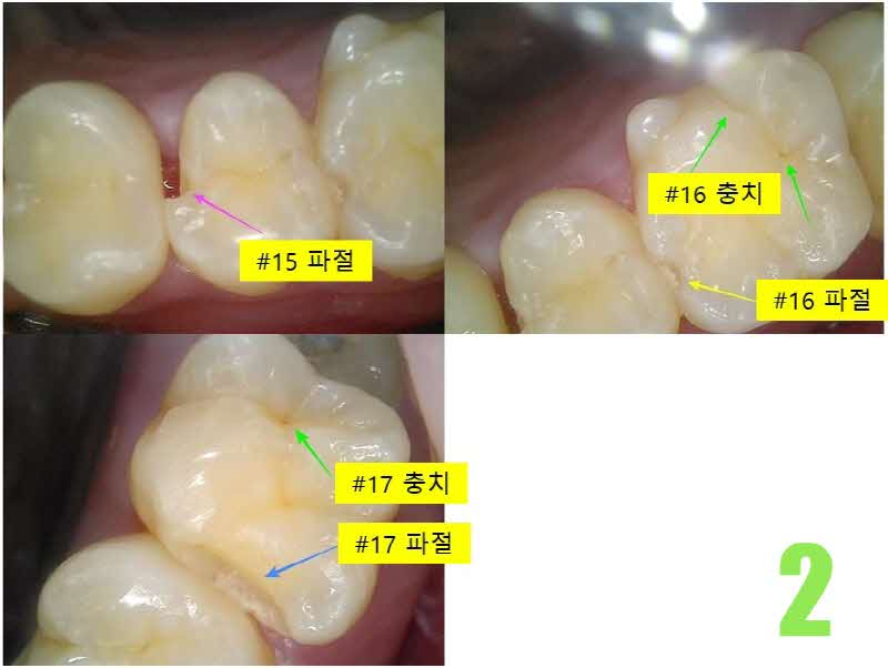2. 초기충치_s.jpg