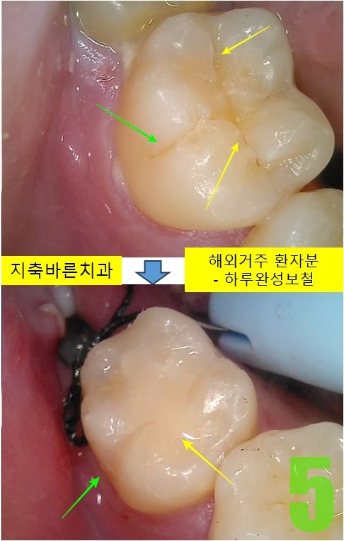 5. #47 하루완성보철.jpg