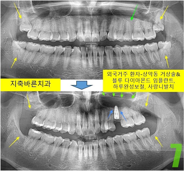 7. #25 임플 식립.jpg